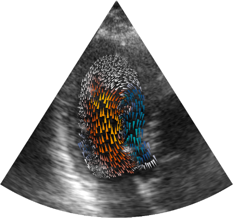 Fig : Cartographie vectorielle de l'écoulement intraventriculaire 