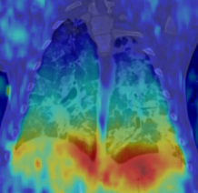 magnintude of deformations derived from image registration and superimposed on the originalCT scan acquired at expiration