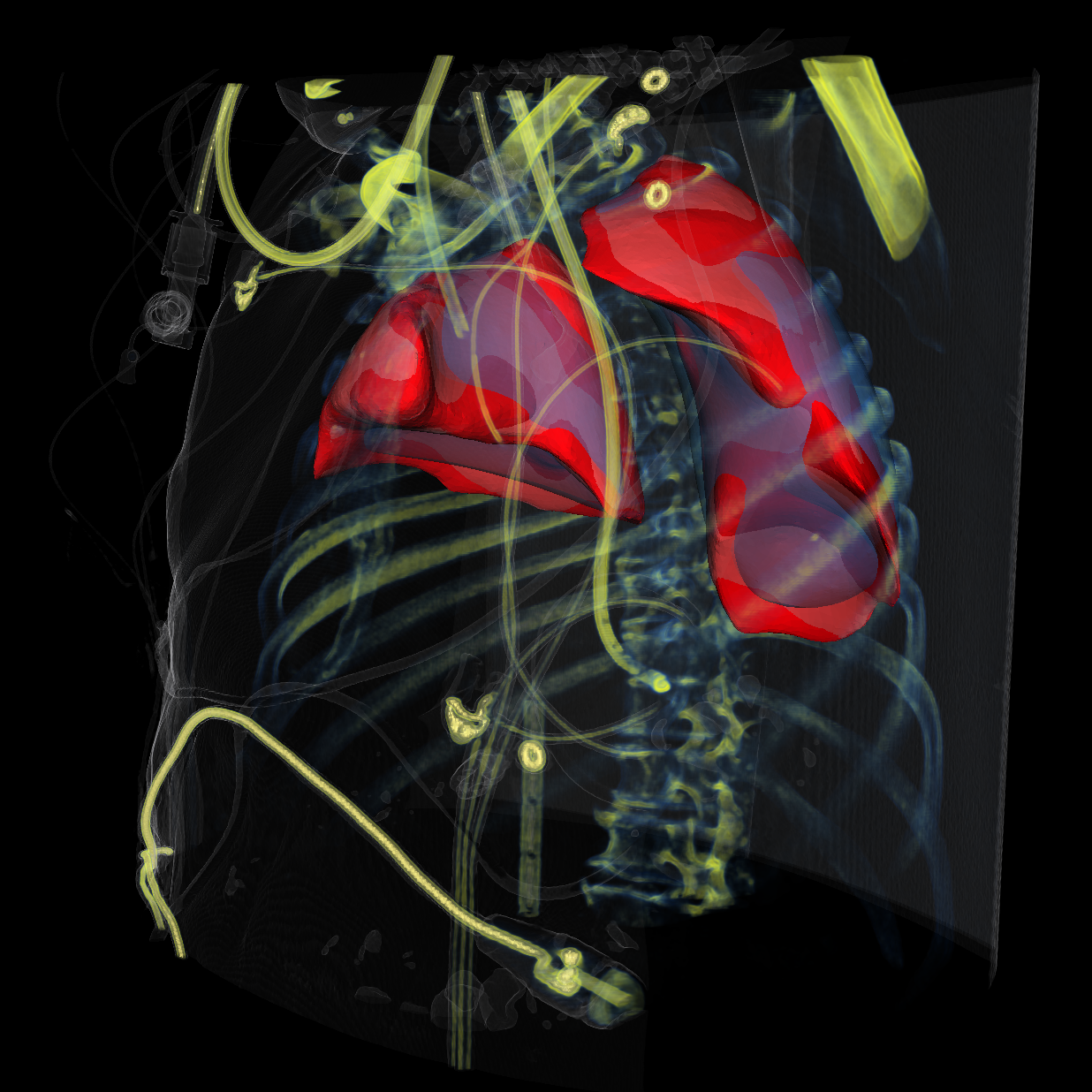 Lungs segmented from a CT scan of a patient with severe ARDS