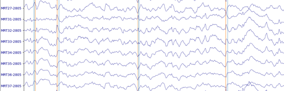 Example of magnetoencephalography data with epileptic spikes annotated, for one patient.