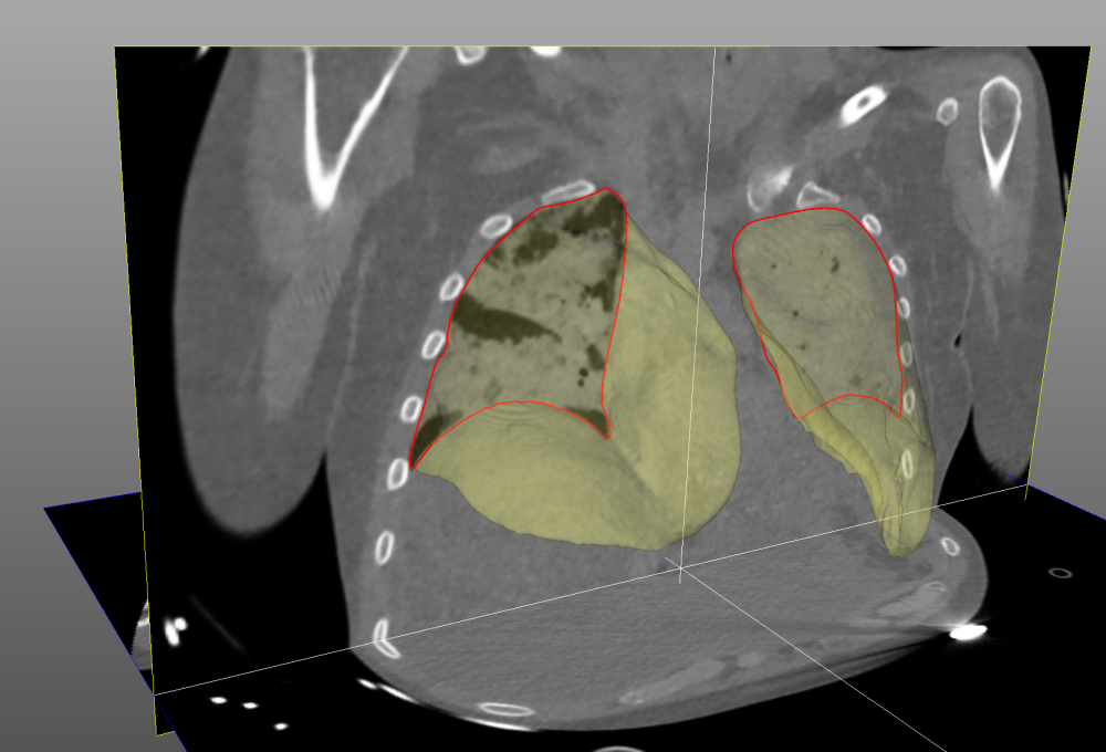 Automatic lung segmentation in a severe ARDS case